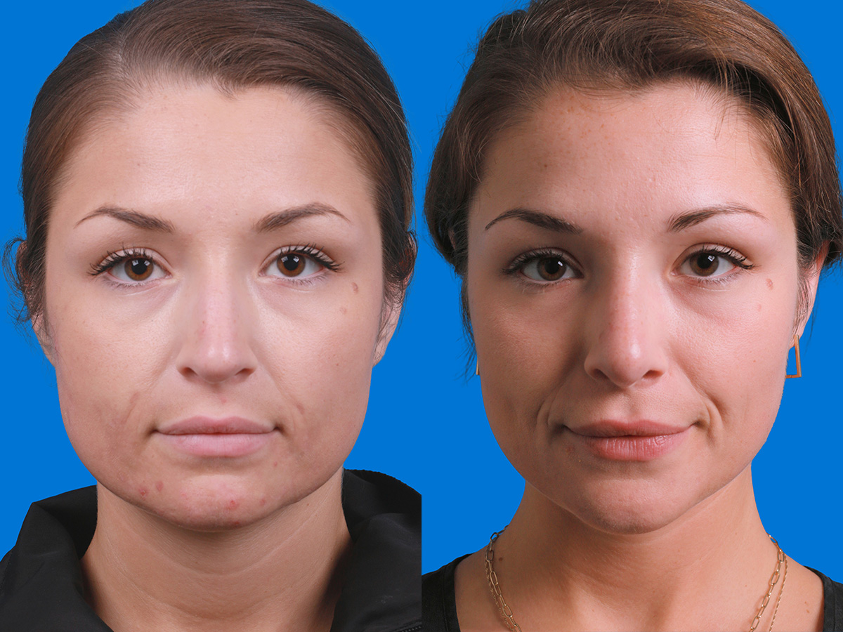 Rhinoplasty Before & After Gallery - Patient 289192 - Image 1
