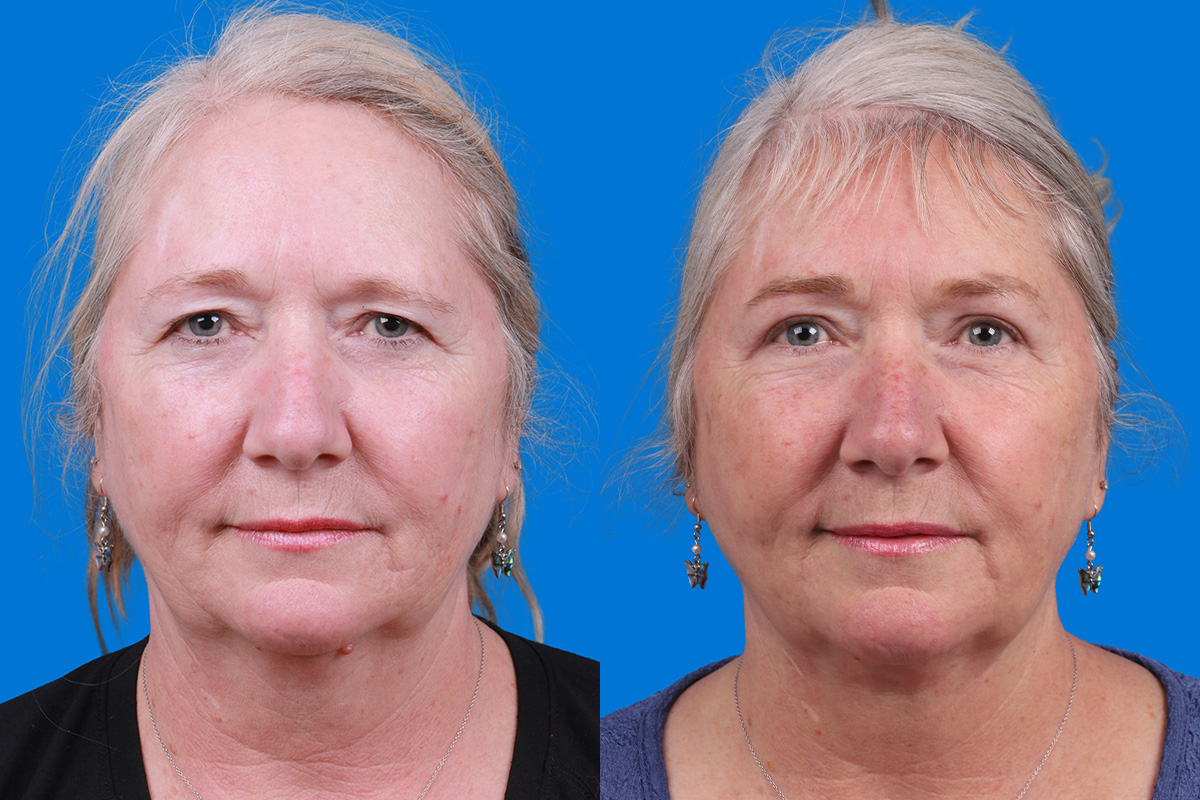 Brow Lift Before & After Gallery - Patient 103374 - Image 1