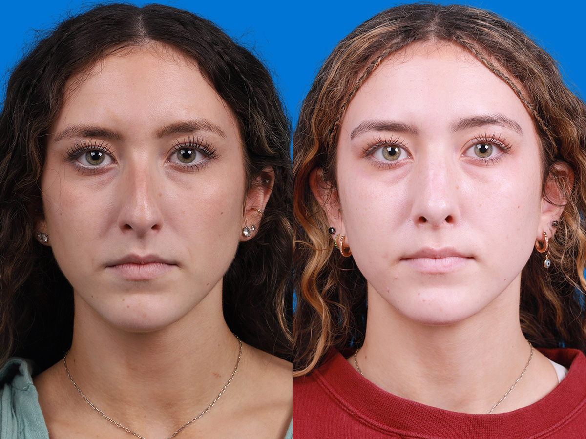 Rhinoplasty Before & After Gallery - Patient 299221 - Image 1