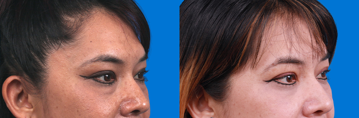 Eyelid Surgery Before & After Gallery - Patient 346723 - Image 2