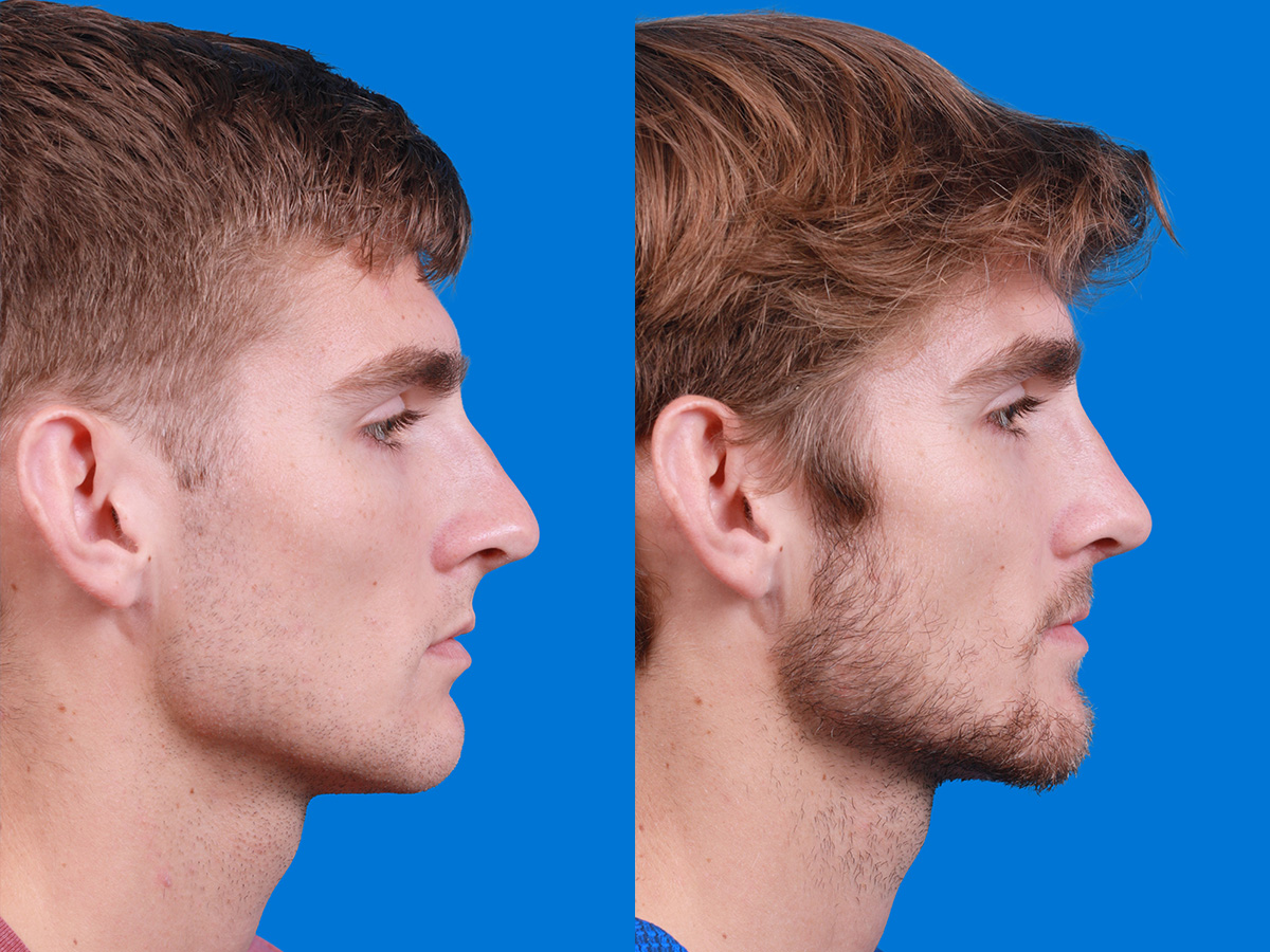 Rhinoplasty Before & After Gallery - Patient 174463 - Image 2