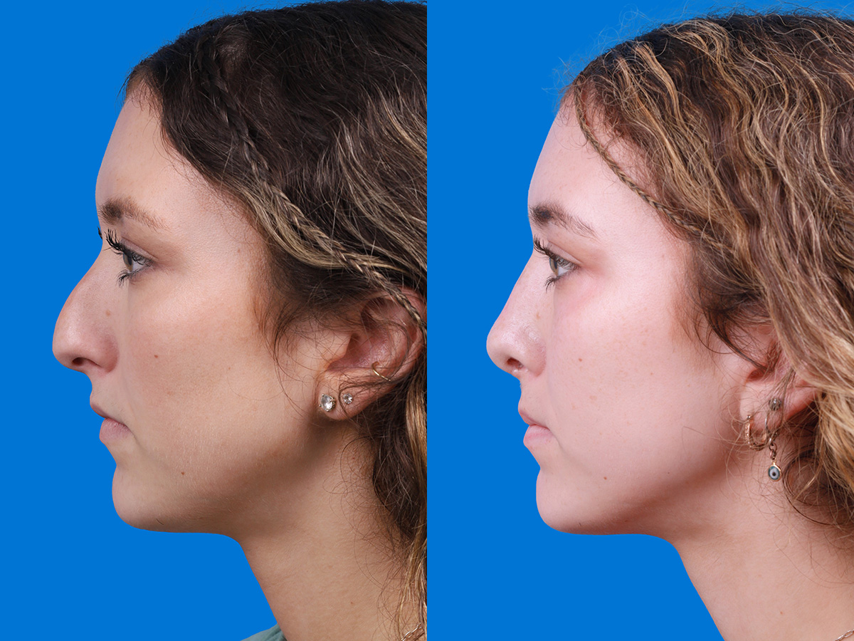 Rhinoplasty Before & After Gallery - Patient 299221 - Image 2