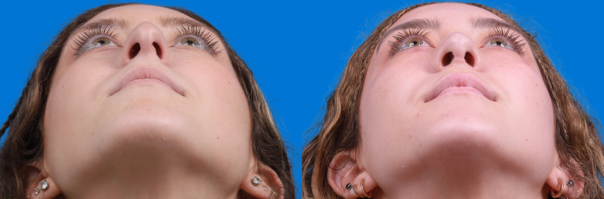 Rhinoplasty Before & After Gallery - Patient 299221 - Image 3