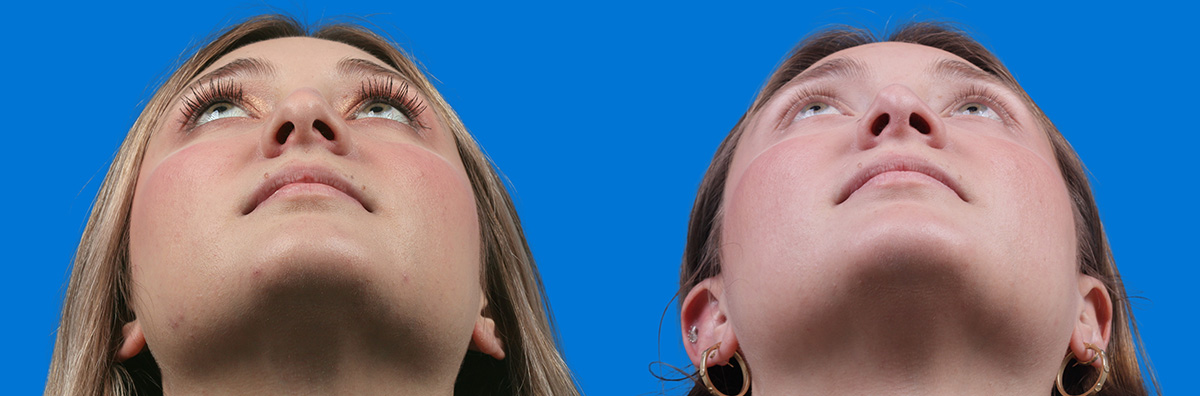 Rhinoplasty Before & After Gallery - Patient 646433 - Image 3