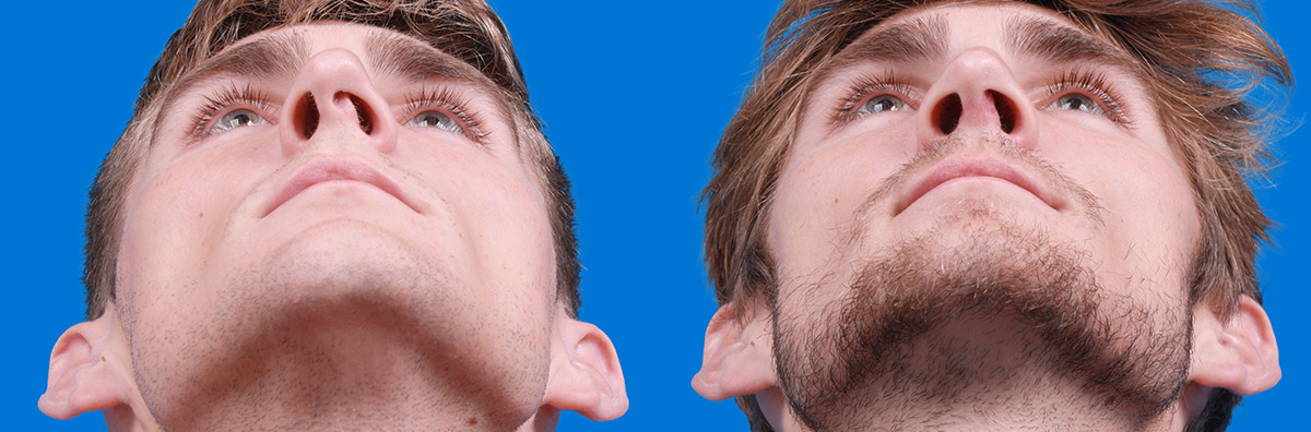 Rhinoplasty Before & After Gallery - Patient 174463 - Image 3