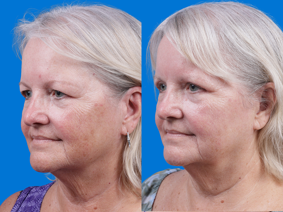 Eyelid Surgery Before & After Gallery - Patient 155299 - Image 3