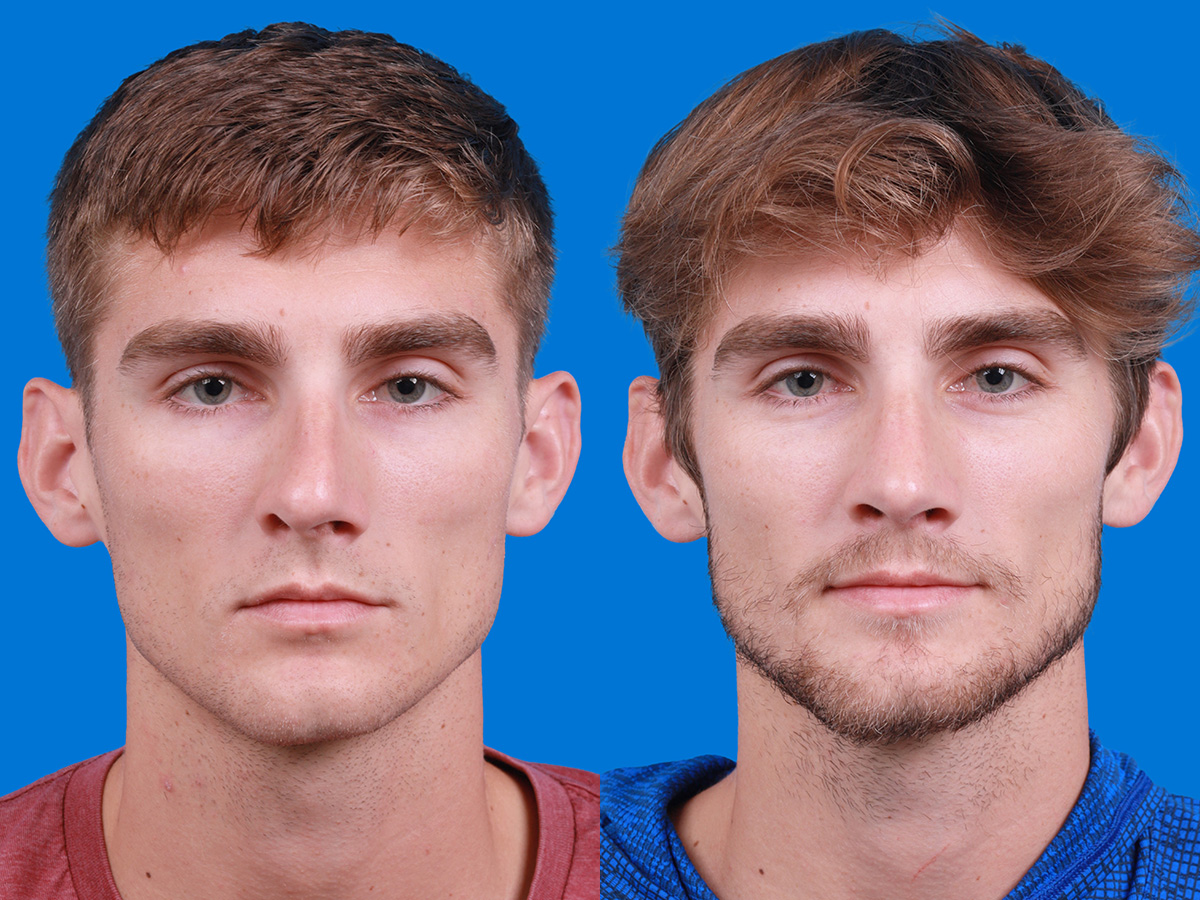 Rhinoplasty Before & After Gallery - Patient 174463 - Image 1