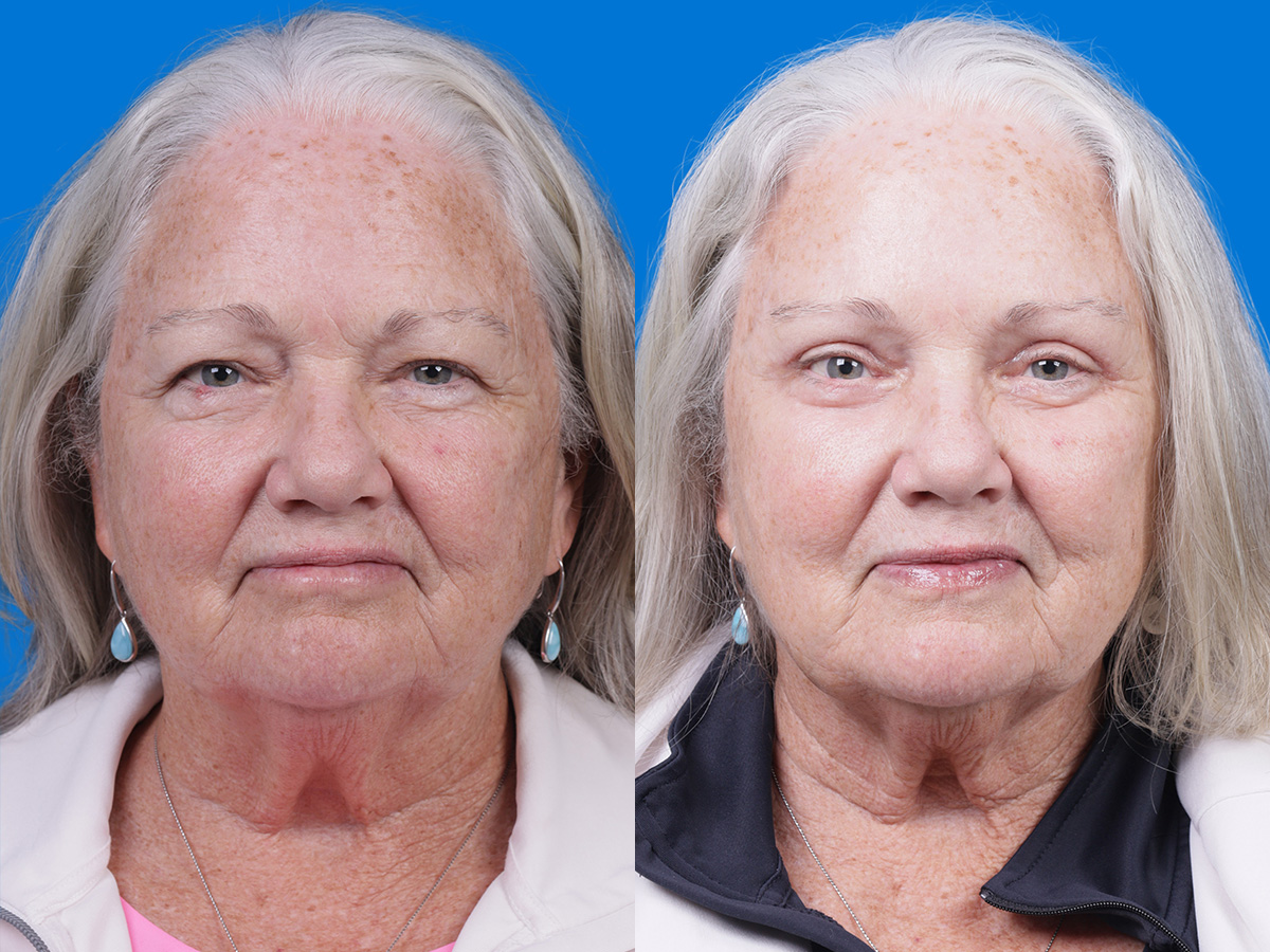 Brow Lift Before & After Gallery - Patient 417190 - Image 1