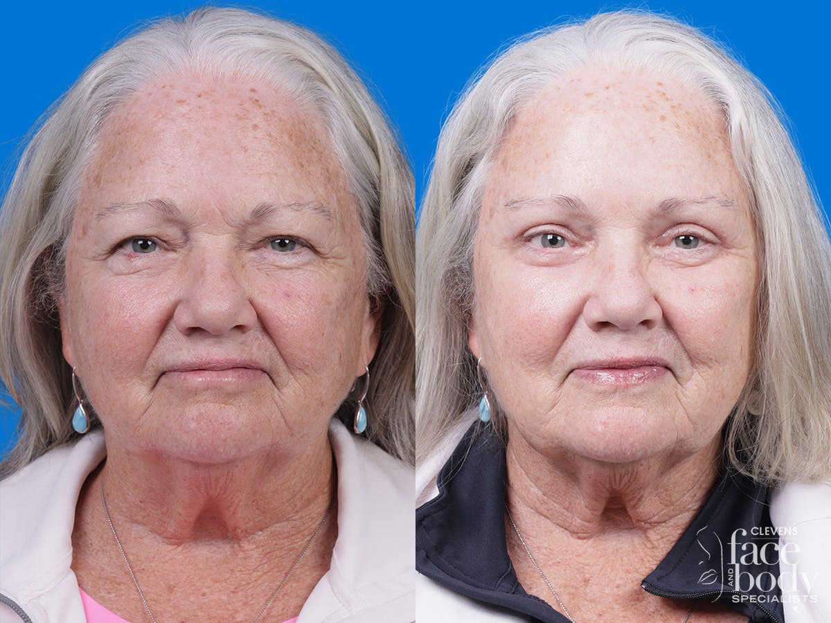 Eyelid Surgery Before & After Gallery - Patient 357388 - Image 1