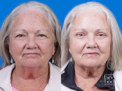 Eyelid Surgery Before & After Gallery - Patient 357388 - Image 1