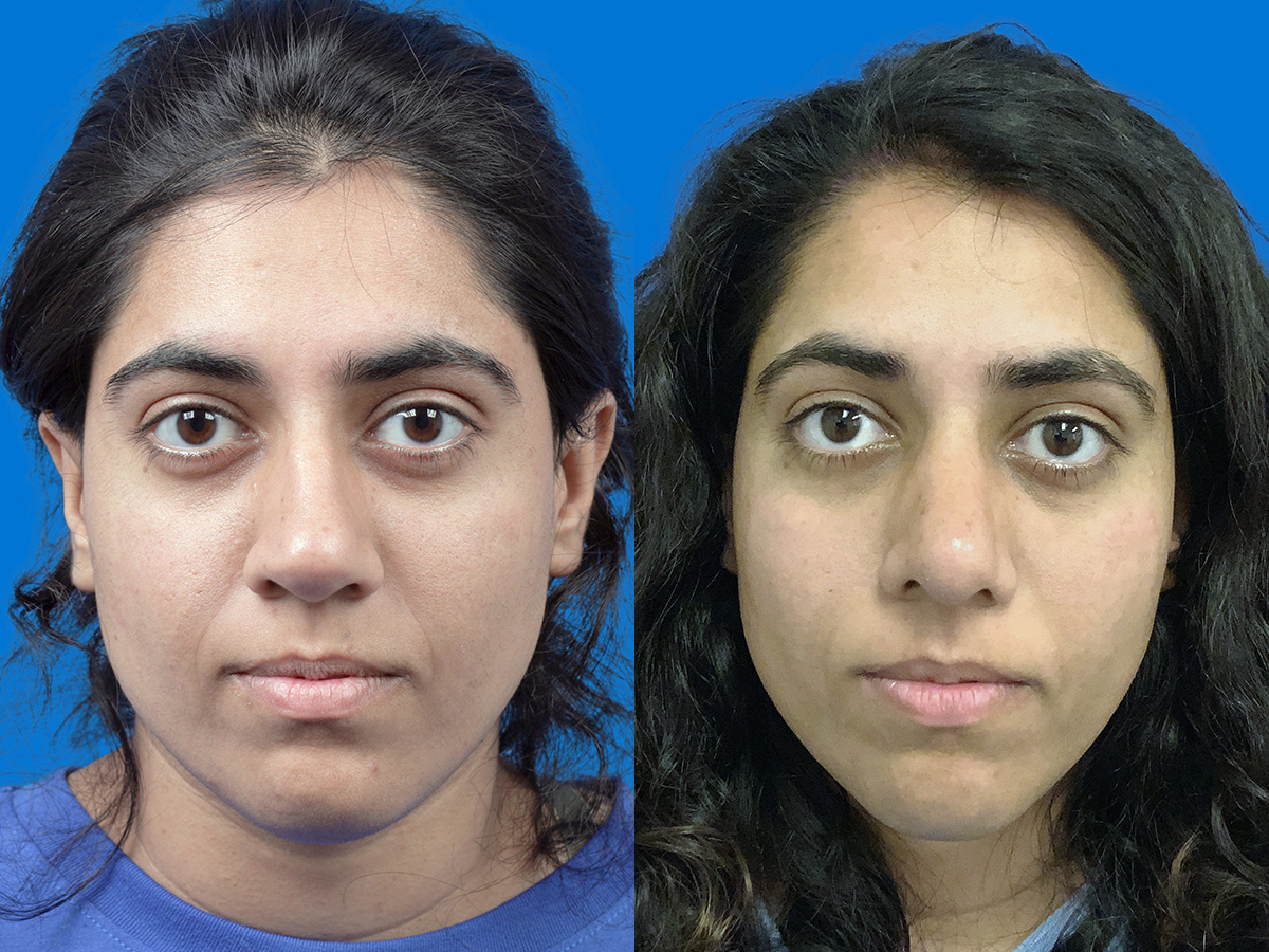 Rhinoplasty Before & After Gallery - Patient 757809 - Image 1