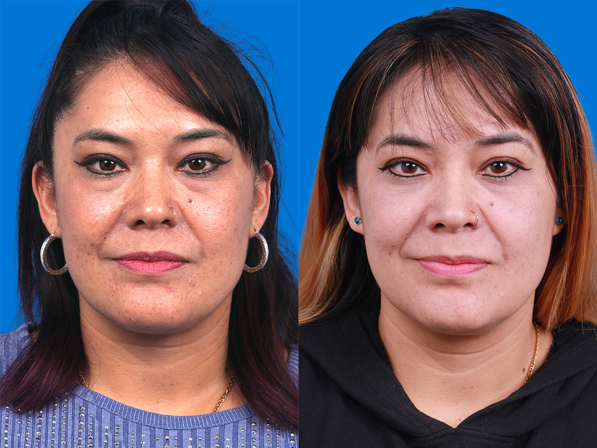 Eyelid Surgery Before & After Gallery - Patient 346723 - Image 1
