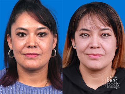 Eyelid Surgery Before & After Gallery - Patient 346723 - Image 1