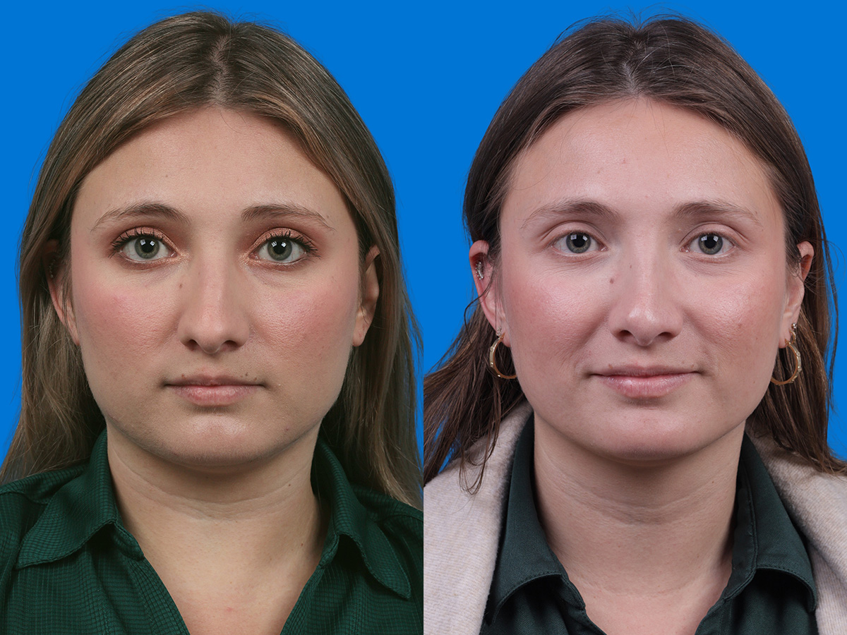 Rhinoplasty Before & After Gallery - Patient 646433 - Image 1