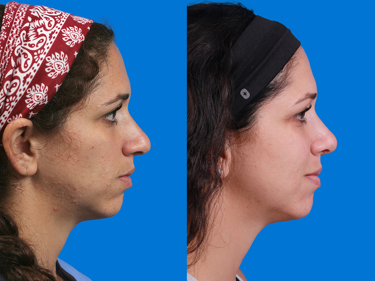 Rhinoplasty Before & After Gallery - Patient 173490 - Image 2