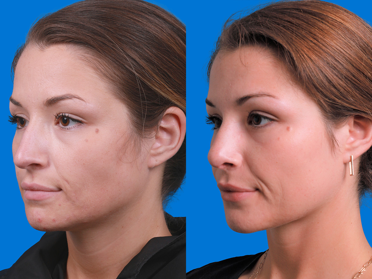 Rhinoplasty Before & After Gallery - Patient 289192 - Image 2