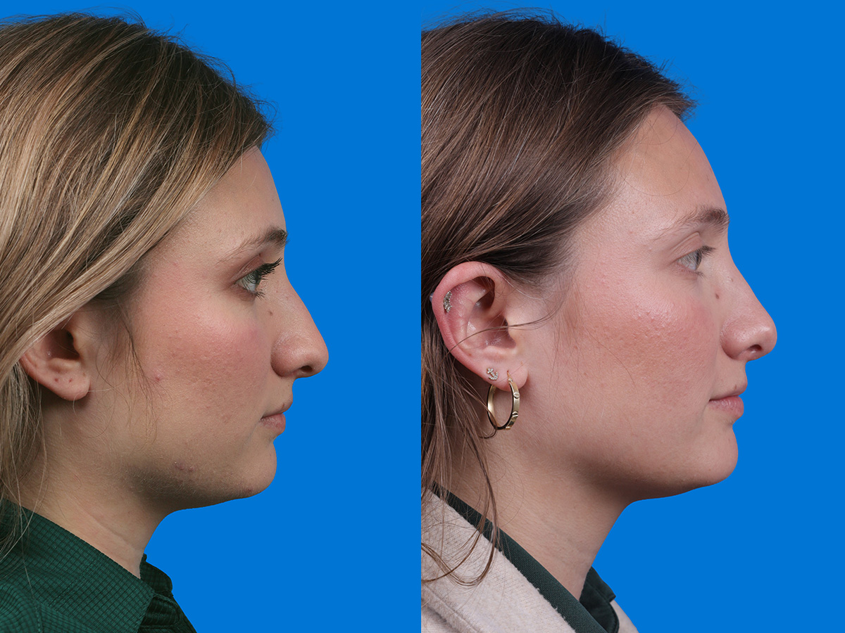 Rhinoplasty Before & After Gallery - Patient 646433 - Image 2