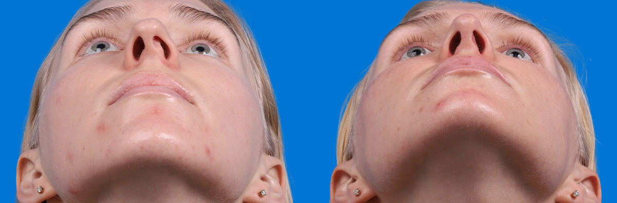 Rhinoplasty Before & After Gallery - Patient 120813 - Image 3