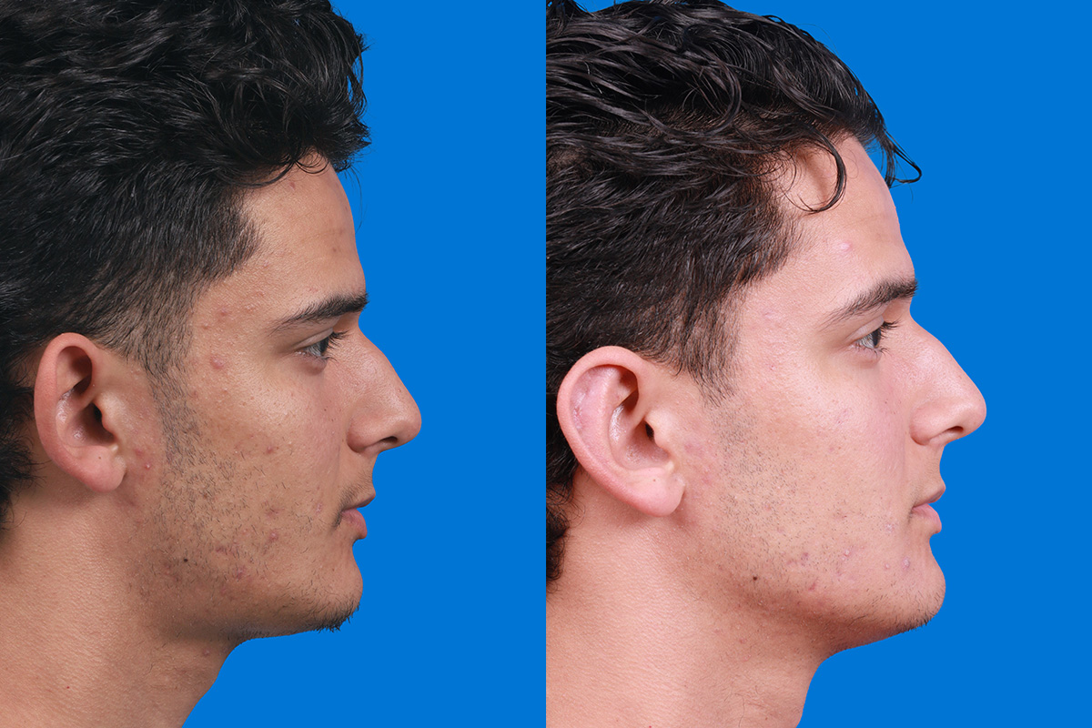 Ear Surgery Before & After Gallery - Patient 289291 - Image 3