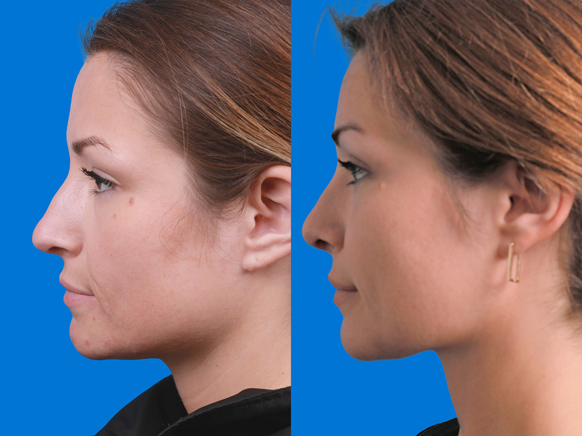 Rhinoplasty Before & After Gallery - Patient 289192 - Image 3