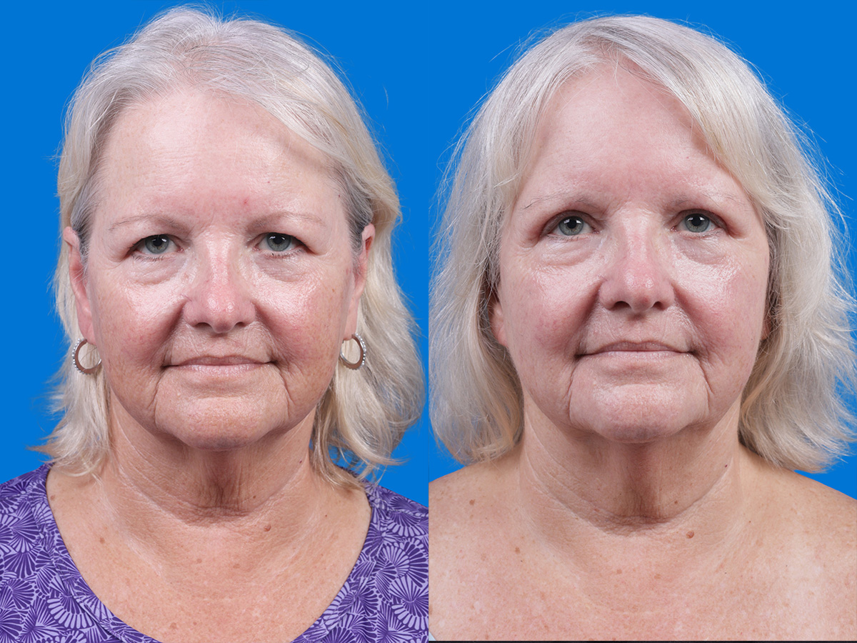 Eyelid Surgery Before & After Gallery - Patient 155299 - Image 1