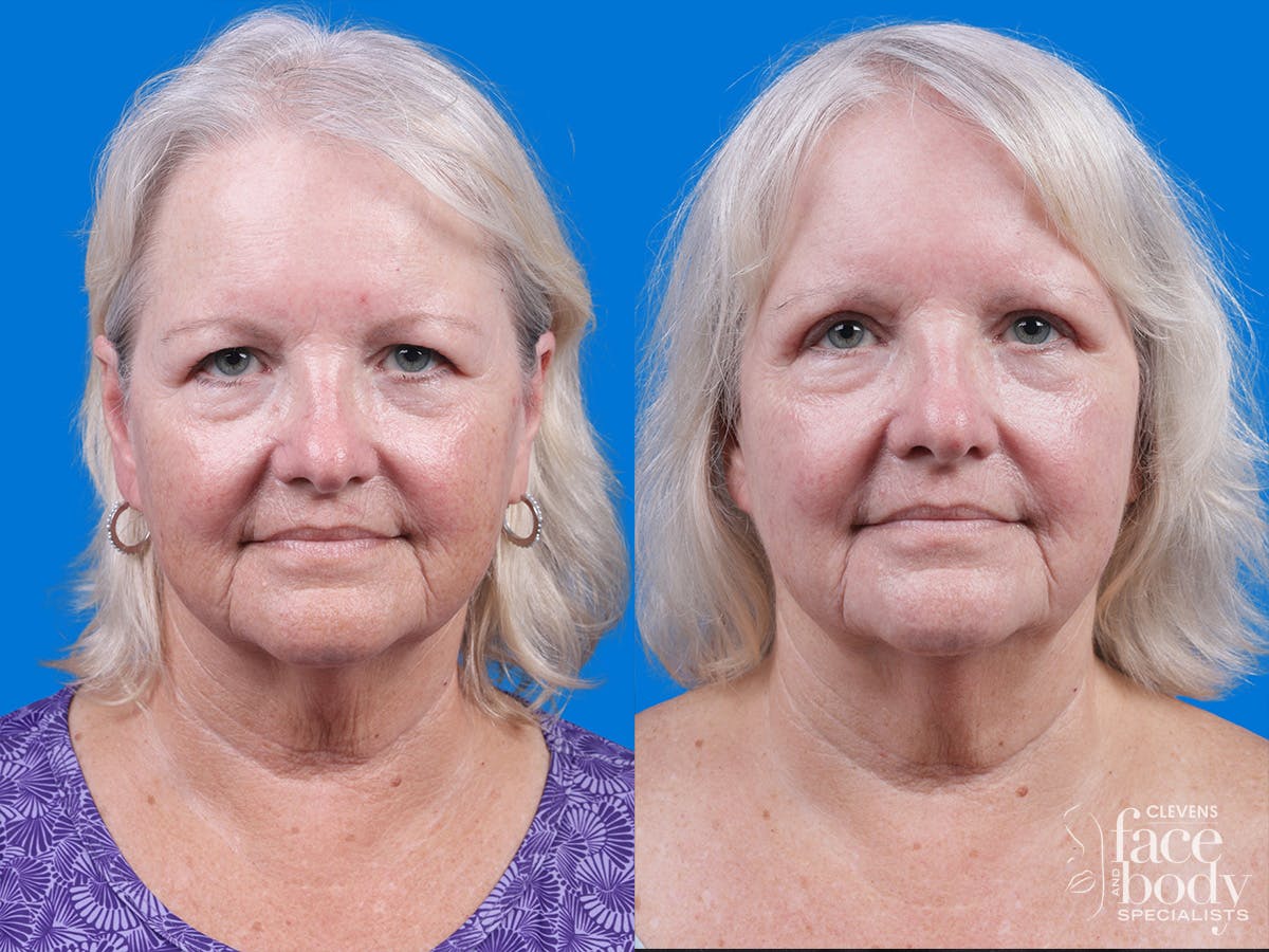 Eyelid Surgery Before & After Gallery - Patient 155299 - Image 1