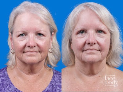Eyelid Surgery Before & After Gallery - Patient 155299 - Image 1