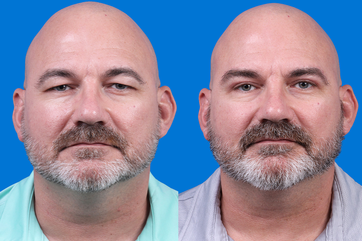 Brow Lift Before & After Gallery - Patient 202449 - Image 1