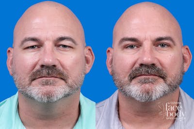 Eyelid Surgery Before & After Gallery - Patient 298335 - Image 1