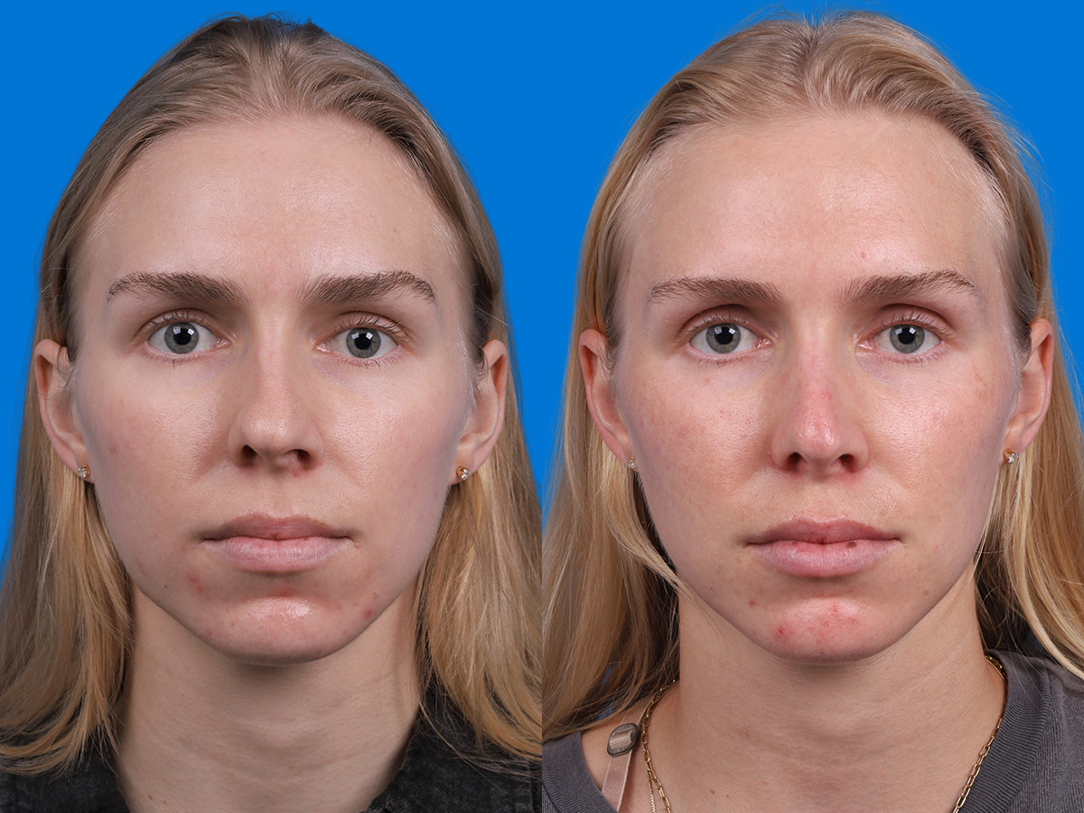 Rhinoplasty Before & After Gallery - Patient 120813 - Image 1