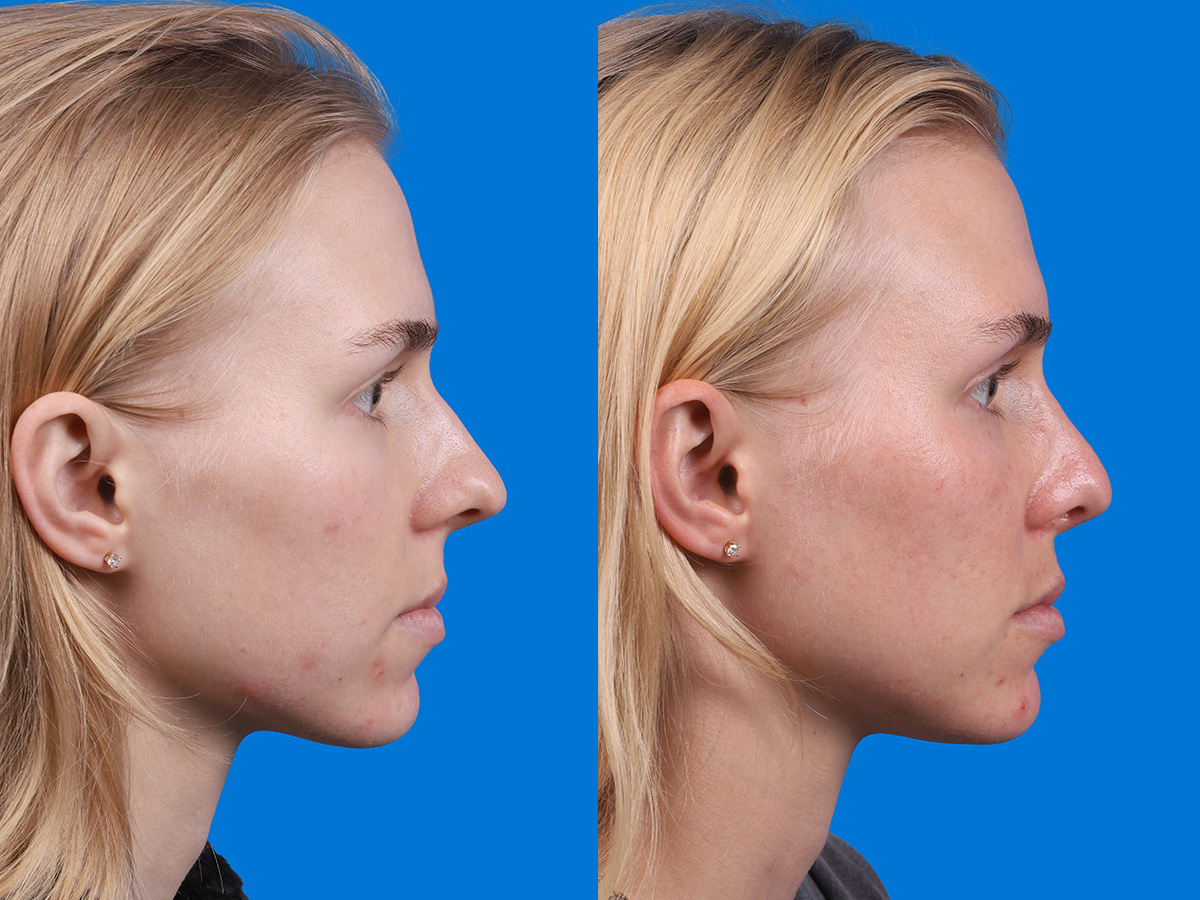 Rhinoplasty Before & After Gallery - Patient 120813 - Image 2