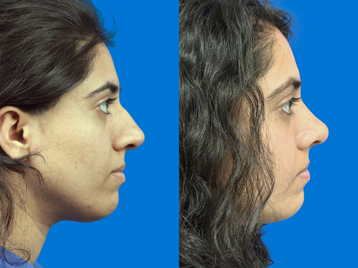 Rhinoplasty Before & After Gallery - Patient 757809 - Image 2