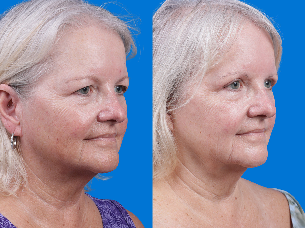 Eyelid Surgery Before & After Gallery - Patient 155299 - Image 2