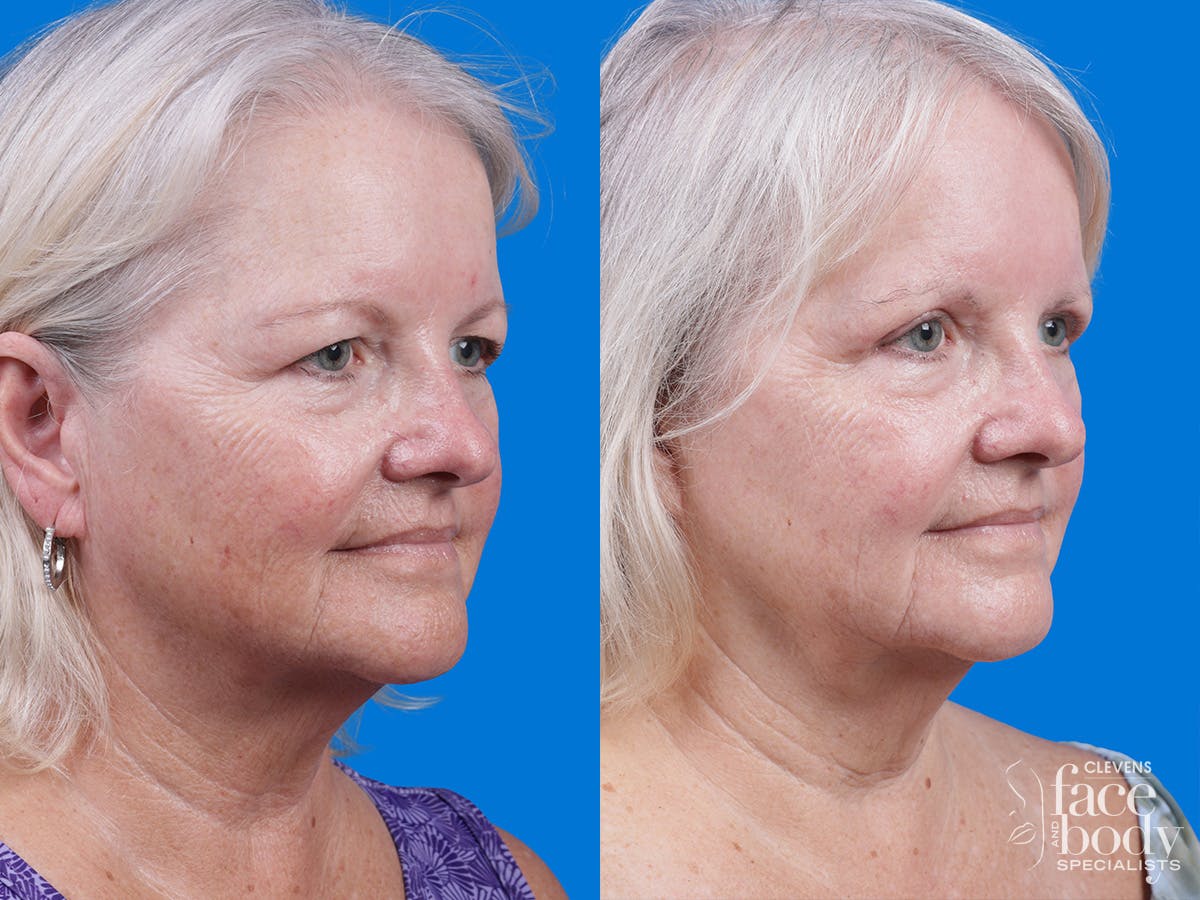 Eyelid Surgery Before & After Gallery - Patient 155299 - Image 2