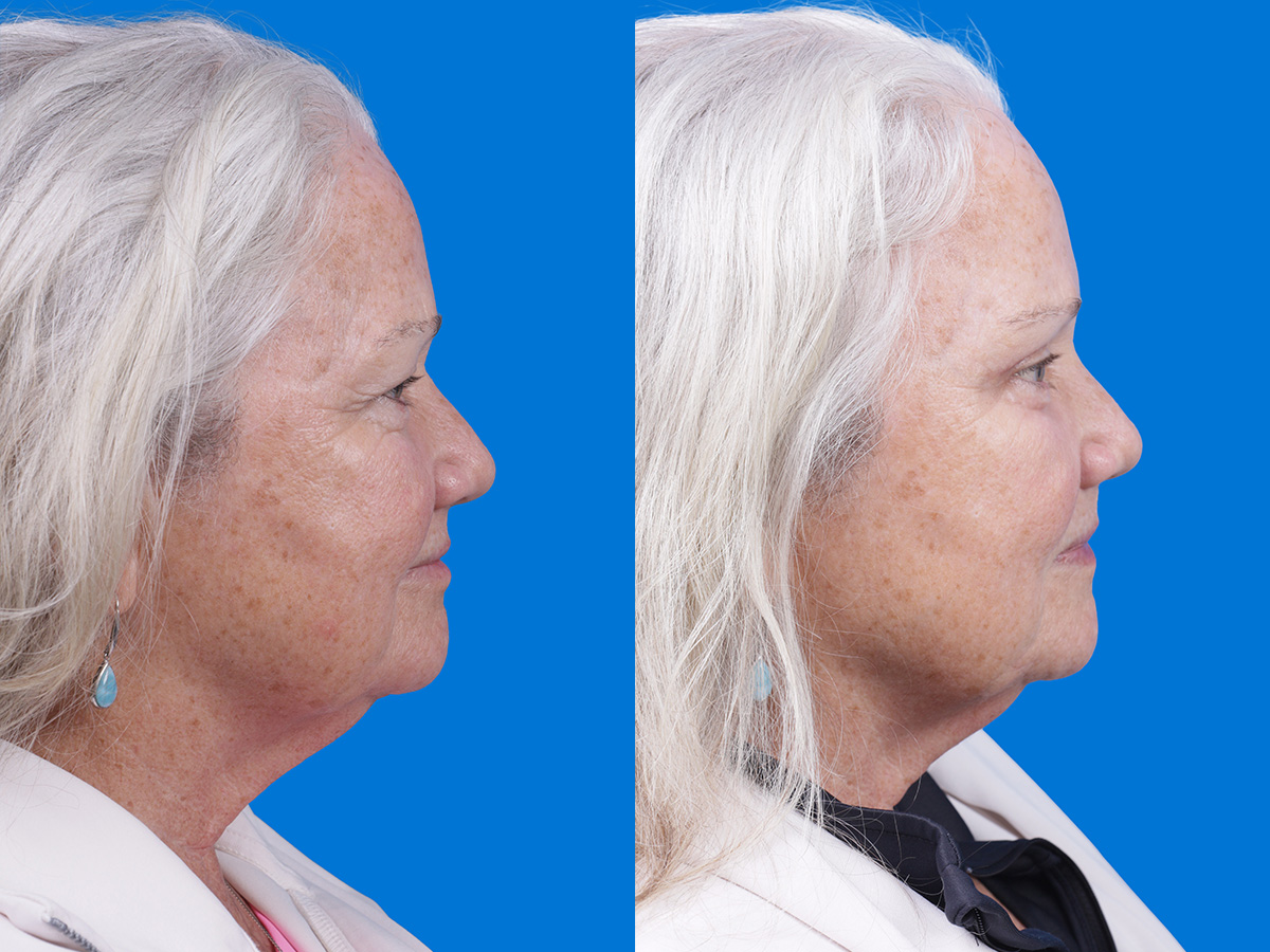 Brow Lift Before & After Gallery - Patient 417190 - Image 3