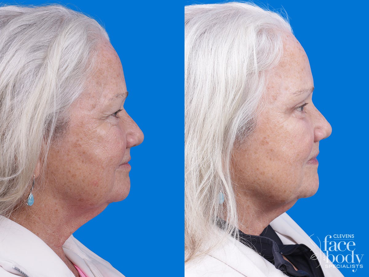 Eyelid Surgery Before & After Gallery - Patient 357388 - Image 3