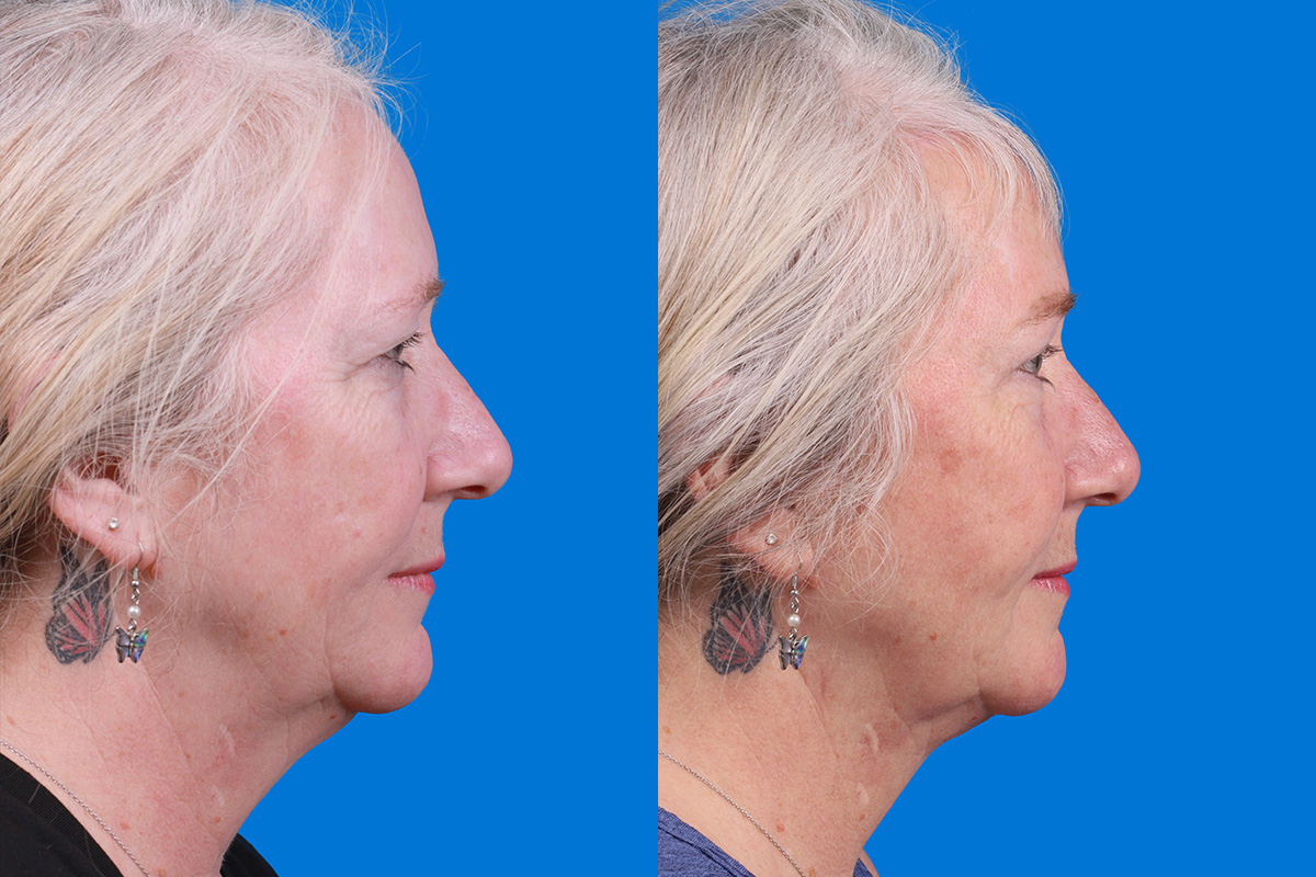 Brow Lift Before & After Gallery - Patient 103374 - Image 3