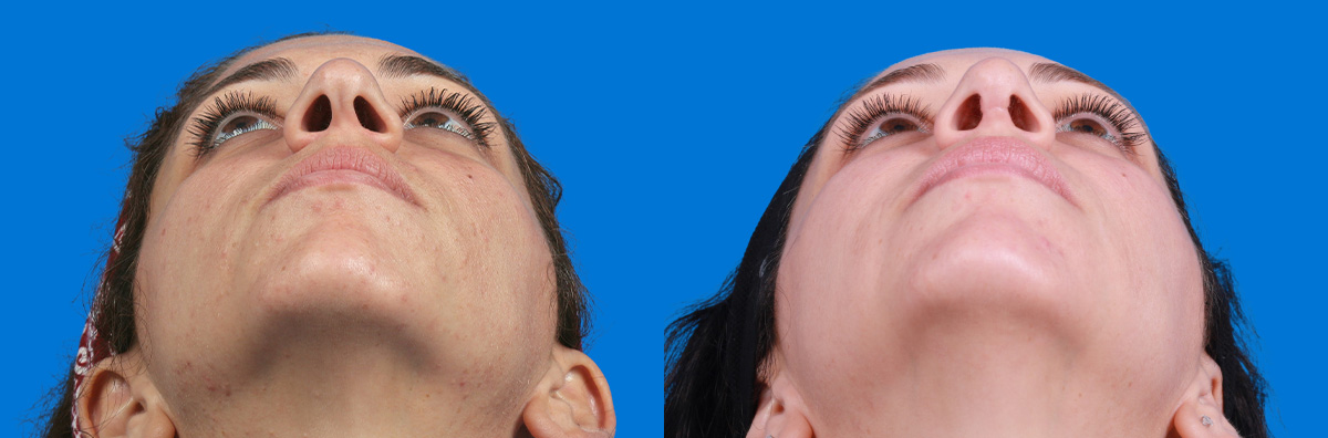 Rhinoplasty Before & After Gallery - Patient 173490 - Image 3