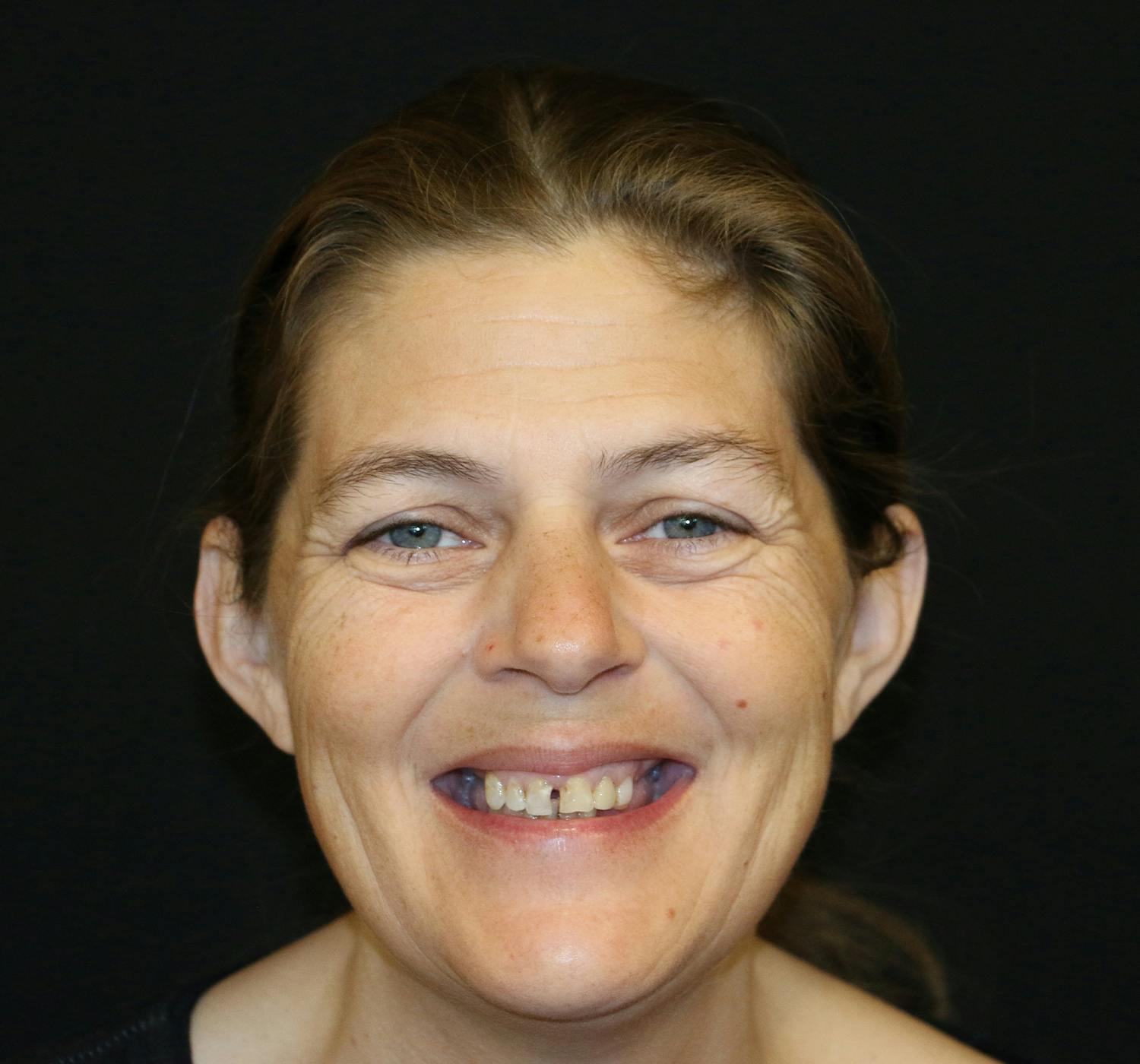 dental implants before and after