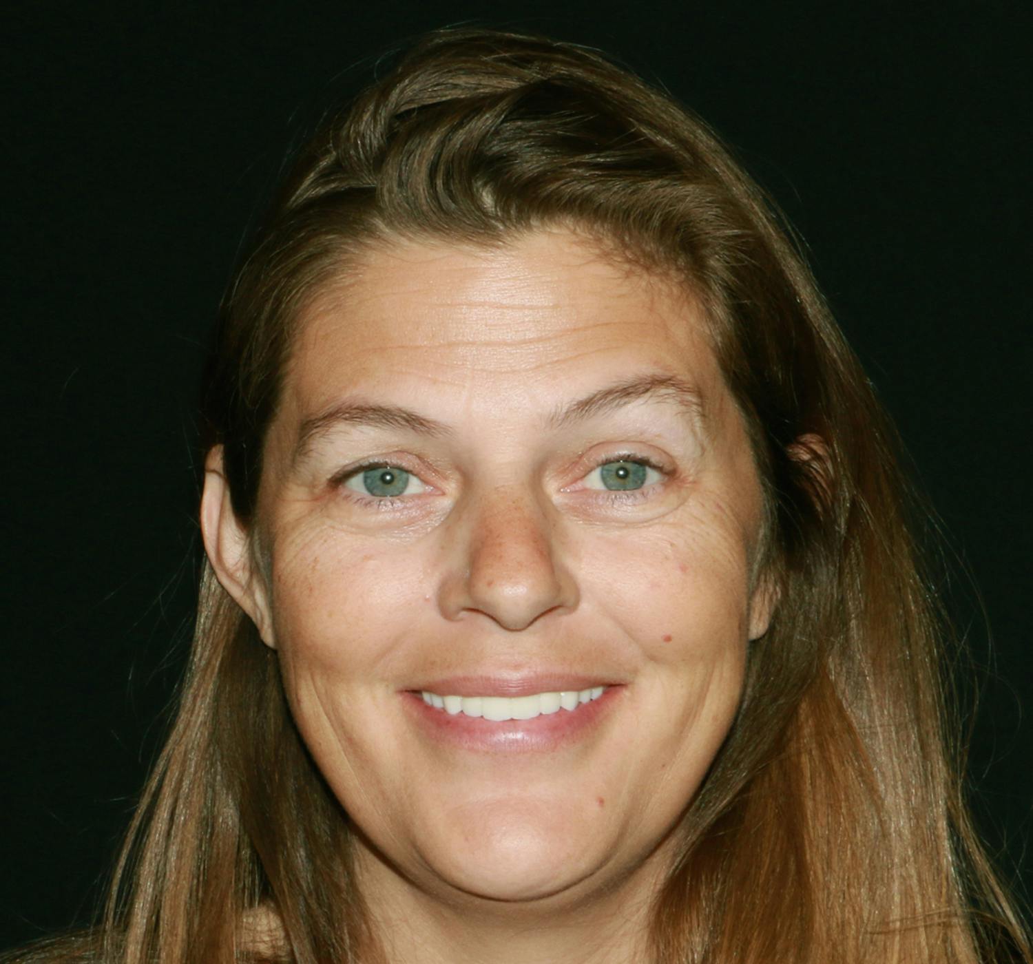 dental implants before and after