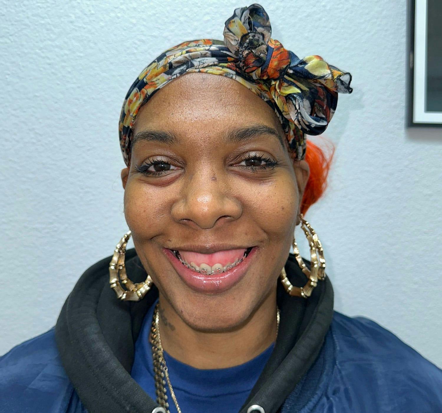 woman before and after zygomatic implants in Burbank