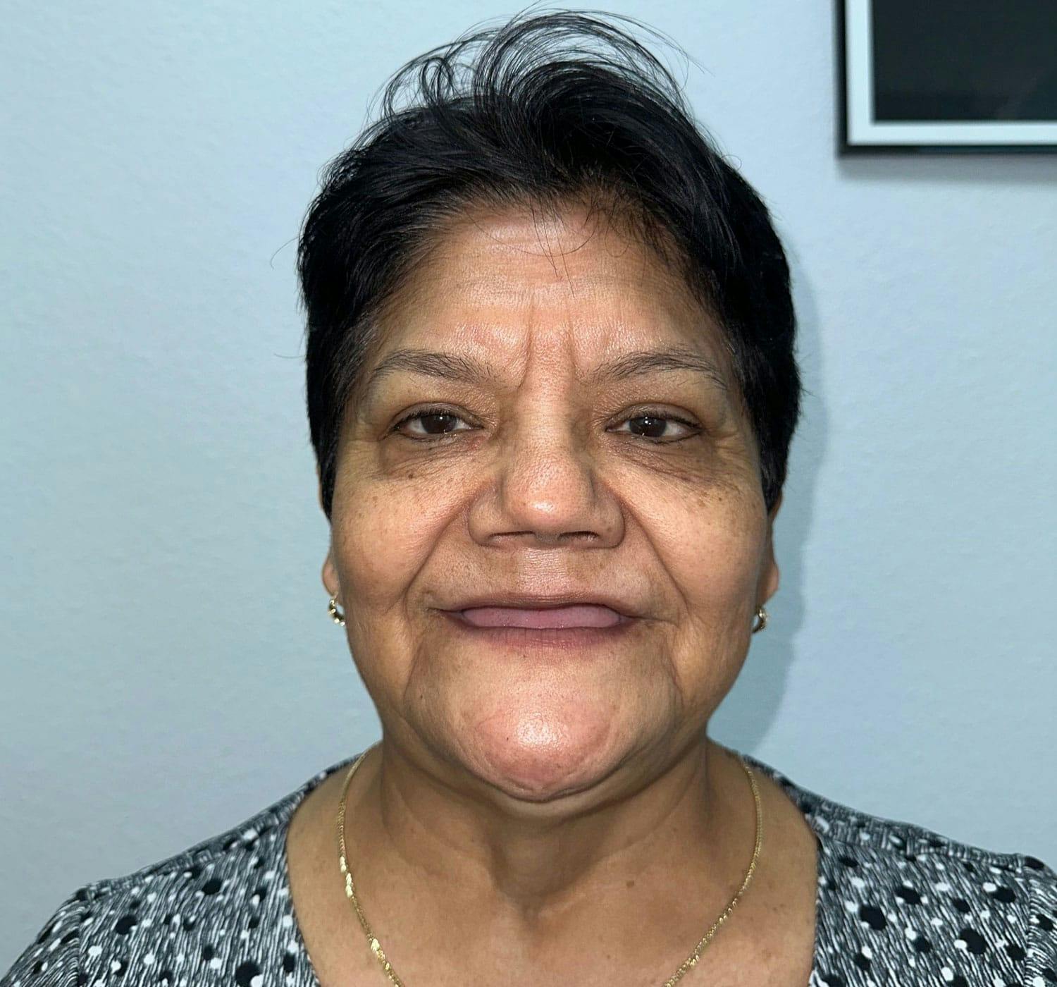 man before and after zygomatic implants in Burbank