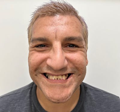 Smile-On-4 Before & After Gallery - Patient 177276 - Image 1