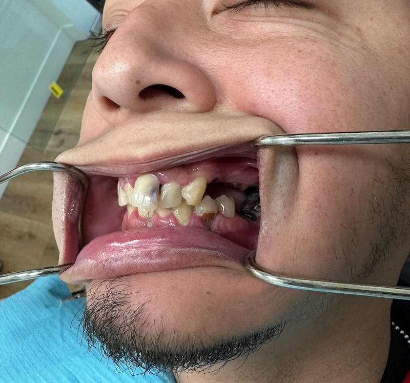 Smile-On-4 Before & After Gallery - Patient 210638 - Image 3