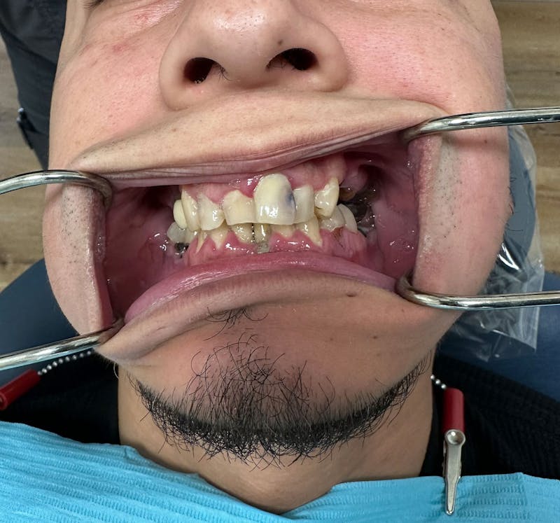Smile-On-4 Before & After Gallery - Patient 210638 - Image 4