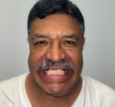 All Before & After Gallery - Patient 424444 - Image 1