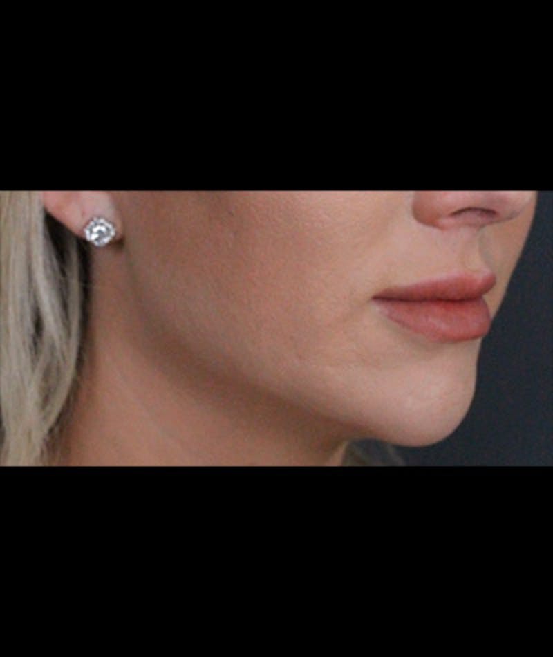 Fillers Before & After Gallery - Patient 109897630 - Image 2