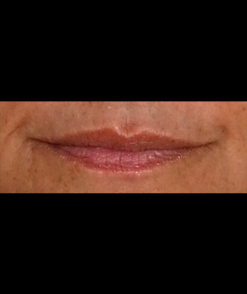 Fillers Before & After Gallery - Patient 109897631 - Image 1