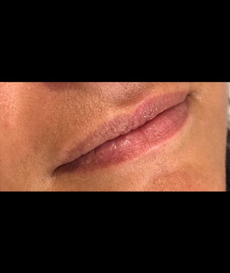 Fillers Before & After Gallery - Patient 109897635 - Image 1