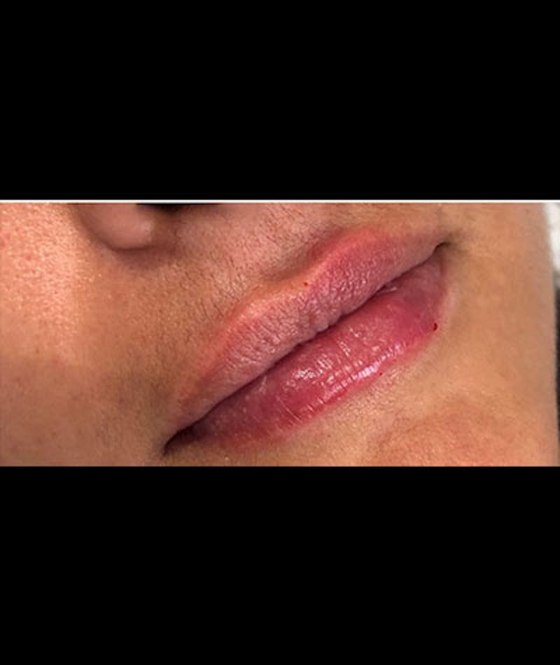 Fillers Before & After Gallery - Patient 109897635 - Image 2